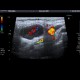 Inflammatory lymph node: US - Ultrasound